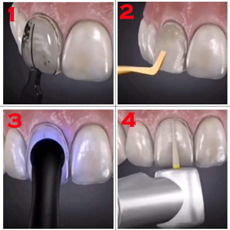 قالب قشرة أسنان قابل للتعقيم ب - مراجعة Teeth Whitening Moulds وسعره