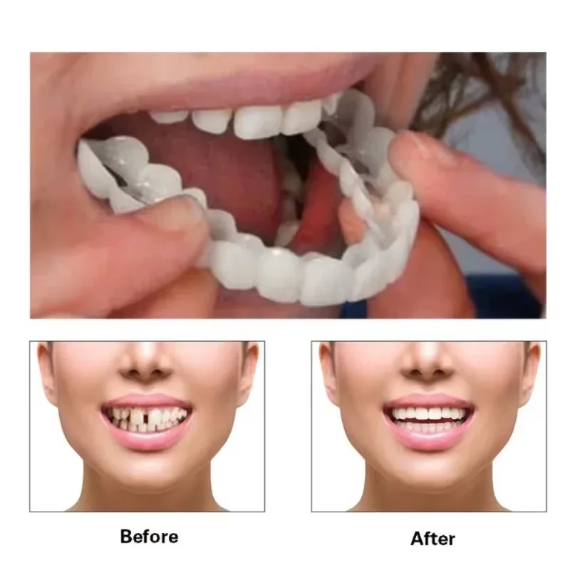 طقم قشرة أسنان قابلة للتركيب،  - مراجعة Teeth Whitening Kit وسعره